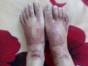 脚烫伤图片,脚部烫伤紧急处理与康复指南